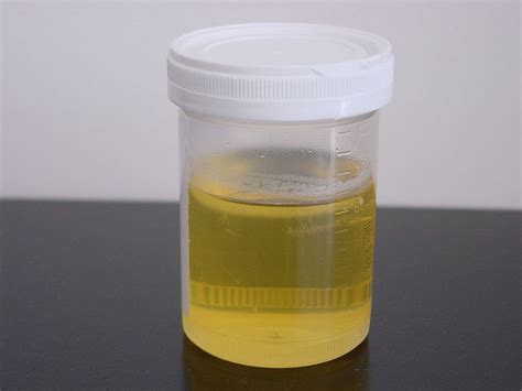 Primary Health Station: Cloudy & Foamy Urine: Is It Proteinuria?