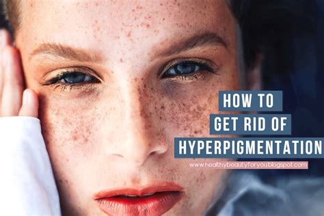 How To Get Rid Of Hyperpigmentation Dermatologist Approved Treatments