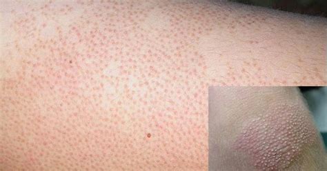 Jenis penyakit kulit yang sering menyerang. Obat Keratosis Pilaris Tradisional ~ Khasiat Teripang Emas