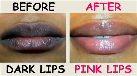 Dark Lips Treatment 100 Natural And Worked For Me Dark Lips To Pink