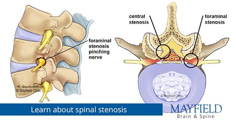 Spinal Stenosis Diagnosis And Treatments Mayfield Brain Spine Cincinnati OH