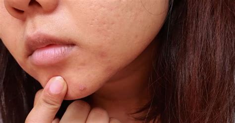 Everything You Need To Know About Treating Cystic Acne According To