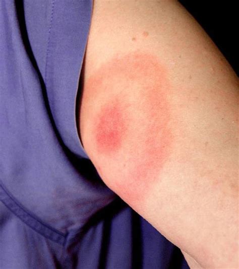 Lyme Disease Rash Photos Early Stage Bulls Eye And Atypical Rashes