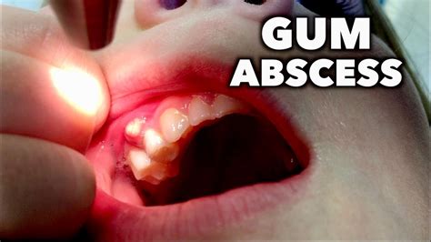 Gum Abscess Dr Paul Dental Clinic