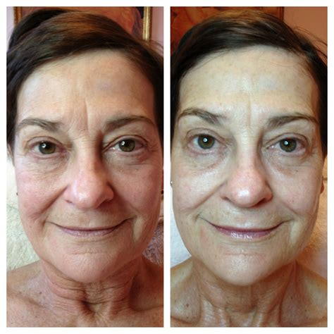microcurrent facial before and after