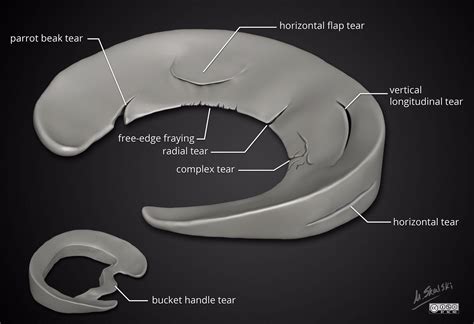 Meniscal Tear Types Illustration By Dr Matt Skalski Twitter