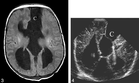 Neonatal Brain Mr Image Taken When The Patient Was 1 Day Old Axial
