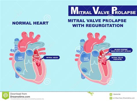 Heart With Mitral Valve Prolapse Stock Vector Illustration Of