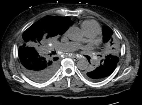 Differential Diagnosis Calcified Mediastinal Nodes Lungs