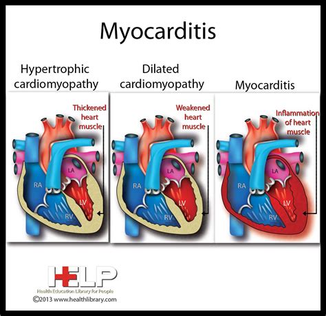 Myocarditis Echocardiogram Cardiomyopathy Echopedia The Gold