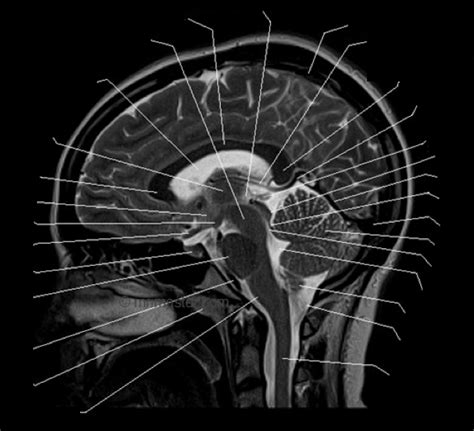 Brain Sagittal View Mri Diagram Quizlet