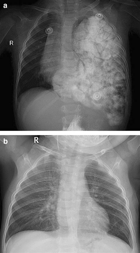 Comparison Of Diaphragm Before A And After B Thoracoscopic Repair