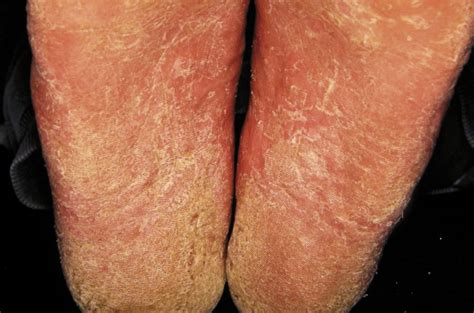 I Have An Itchy Foot Rash Is It Tinea Or Athletes Foot