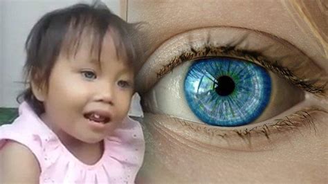Penyebab Mata Bocah Di Bandung Berwarna Biru Termasuk Langka Warga 3