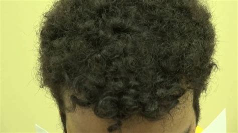 First of all afro hair transplants are becoming very popular. FUE Hair Transplant Result 1 Year Follow Up Curly Black ...