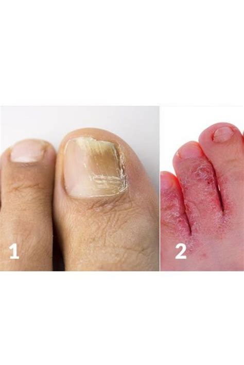 Two Pictures Showing Different Stages Of Toenails And How To Use Them