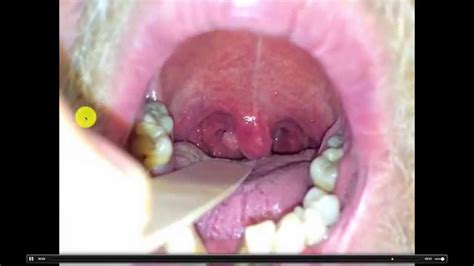 Sore Throat Red Bumps Sore Nodules Cause Can Throat Thyroid Point6