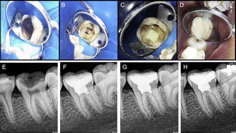 Comparative Evaluation Of Postoperative Pain And Success Rate After