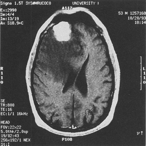 Frontal Lobe Tumor Patient 2 Presented With Personality Change From