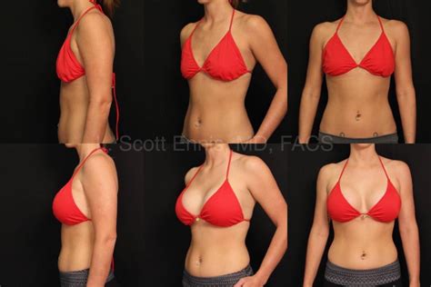 Ennis Plastic Surgery Offers Breast Augmentation With No Scar On The Breast