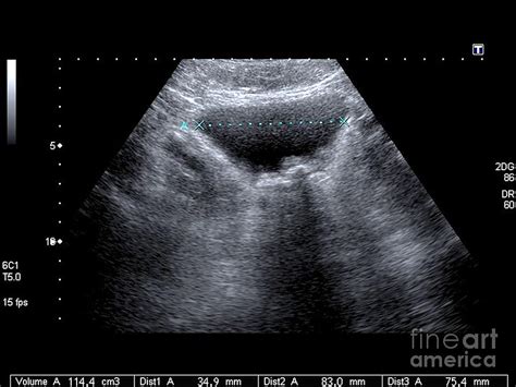 Urinary Bladder Ultrasound