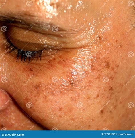 Pigmented Spots On The Face Pigmentation On Cheeks Stock Photo Image