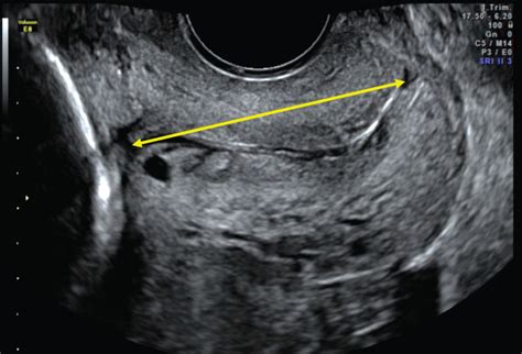 How To Measure Cervical Length Kagan 2015 Ultrasound In