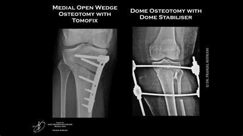 Dome Osteotomy Tibia For Knee Joint Preservation Youtube