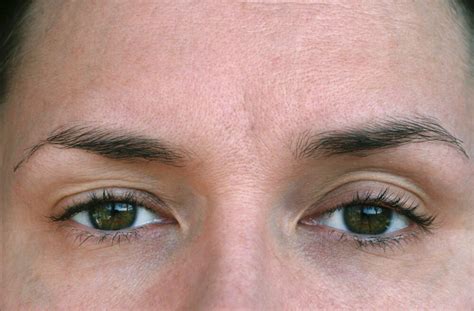 Eyelid Disorders Boca Raton Eyelid Surgery Delray Beach