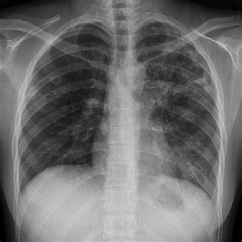 Tuberculosis Chest X Ray Findings