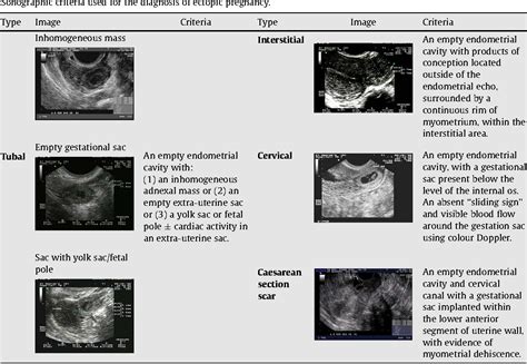 Pdf Diagnosis Of Ectopic Pregnancy With Ultrasound Semantic Scholar
