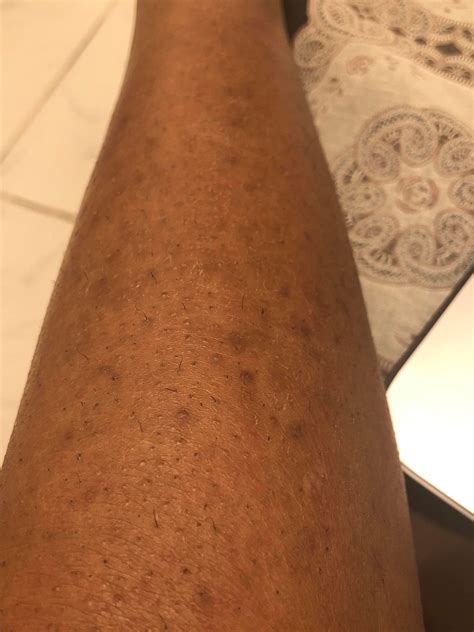 How To Cover Hyperpigmentation On Legs Justinboey