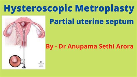 HYSTEROSCOPIC METROPLASTY PARTIAL UTERINE SEPTUM BY DR ANUPAMA SETHI