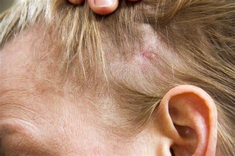 Cures For Scalp Fungus Healthy Living