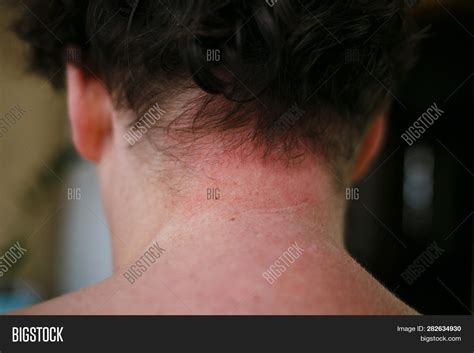 Skin Allergy Symptoms Image And Photo Free Trial Bigstock