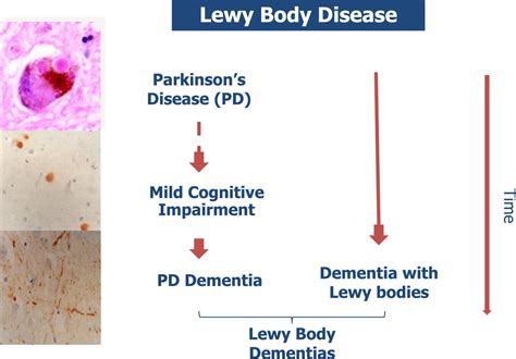 The Clinical Characteristics Of Dementia With Lewy Bodies And A