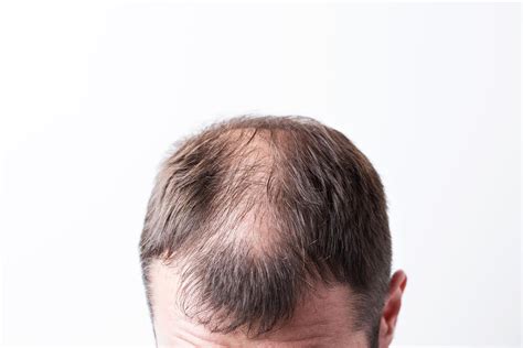 Laser Hair Growth Regeneration Lhgr Chr Clinic