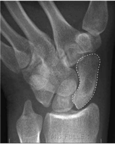 Wrist Trauma Radiographic Evaluation Hand Orthobullets