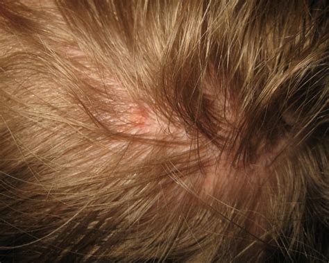 How To Get Rid Of Head Lice Getting Rid Of Head Lice