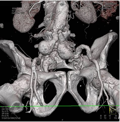 Iliac Artery Aneurysms Vascular Case Studies Ctisus Ct Scanning