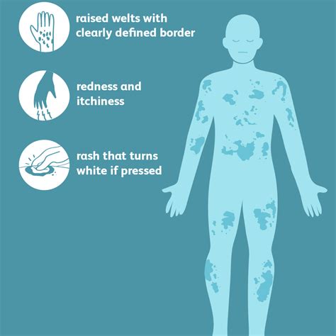 Urticaria Hives Signs Symptoms And Complications