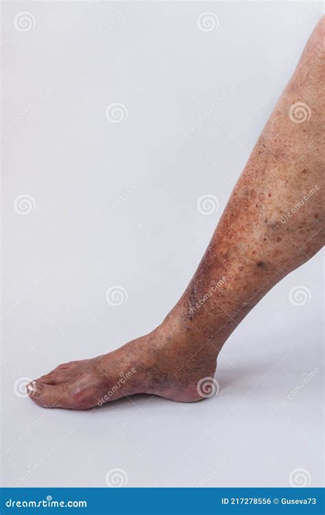 The Leg Of An Elderly Woman With Varicose Veins And Its Complications