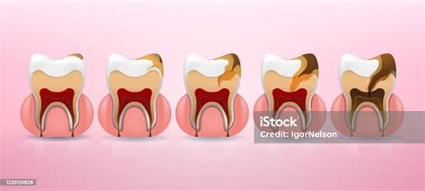 Placement Steps Of Tooth Caries Structure In Realistic Style Stain