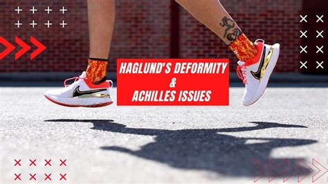 Taping Your Feet For Haglund S Deformity And Achilles Issues You Can