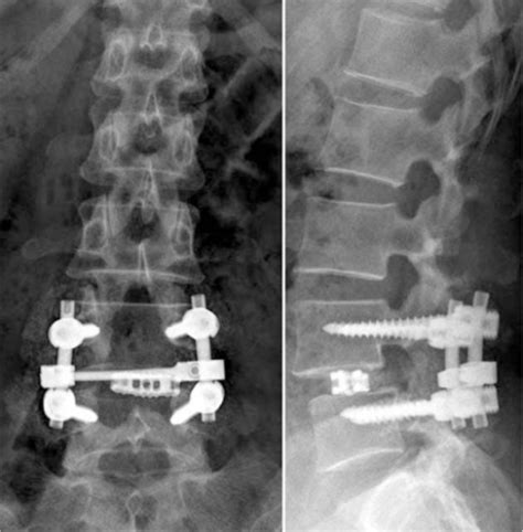 List 105 Background Images L4 L5 S1 Operating Room Lumbar Spinal