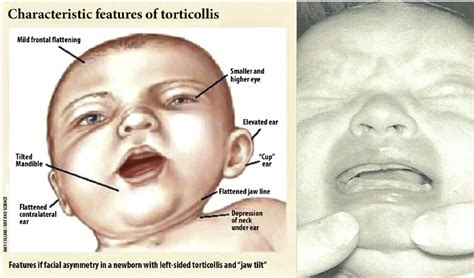Characteristic Features Of Torticollis In The Picture On The Right