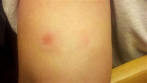 Red Circles Rash Pictures Photos