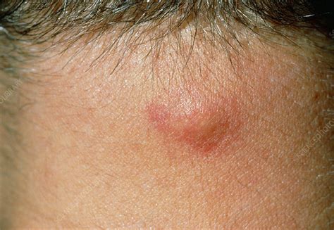 Sebaceous Cysts Are Small Bumps Or Bumps Under The Skin That Extend