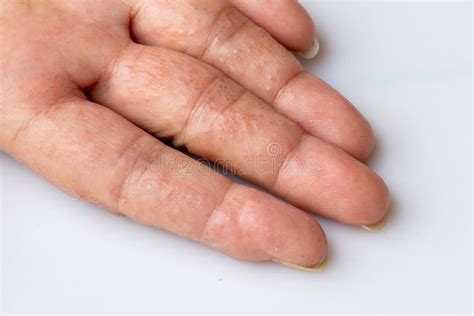 Fechar Dermatite Atópica No Dedo E Também Conhecida Como Conceito De