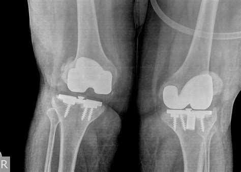 Cureus Bilateral Simultaneous Revision Total Knee Arthroplasty As A Single Staged Procedure A